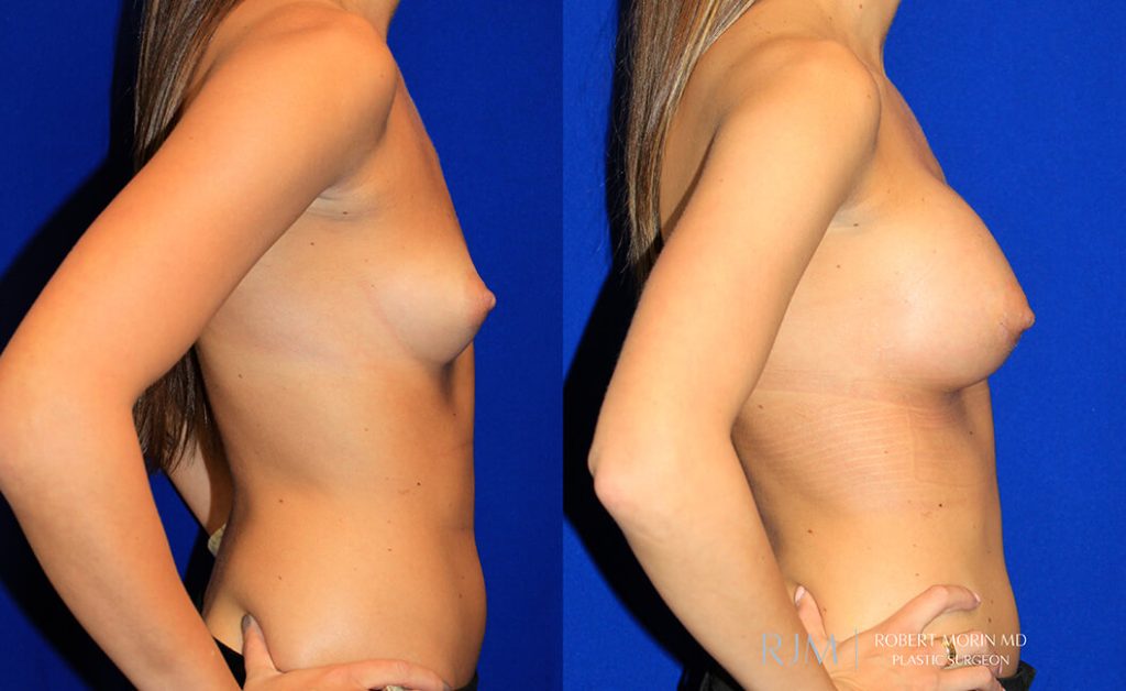  Woman's body, before and after Breast Augmentation treatment in New Jersey, r-side view, patient 19