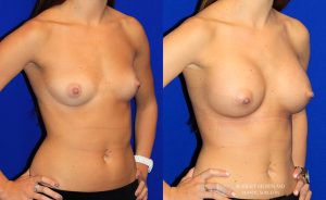  Woman's body, before and after Breast Augmentation treatment, oblique view, patient 16