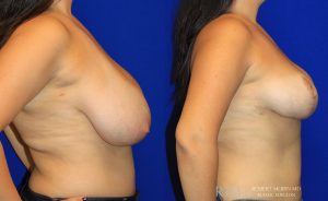  Woman's body, before and after Breast Augmentation treatment, r-side view, patient 34