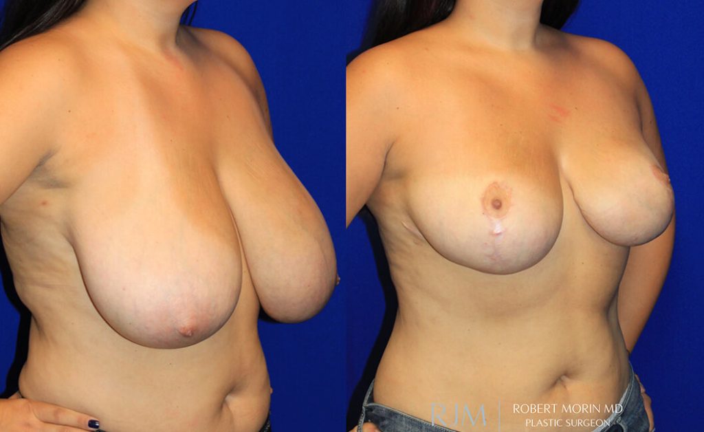  Woman's body, before and after Breast Augmentation treatment in New Jersey, oblique view, patient 37