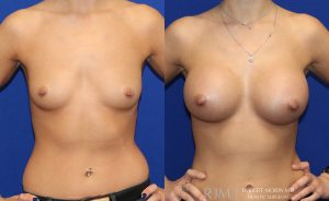  Woman's body, before and after Breast Augmentation treatment in New Jersey, front view, patient 1