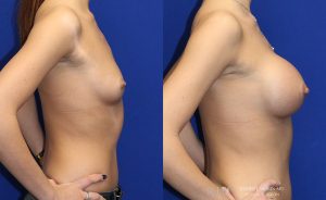  Woman's body, before and after Breast Augmentation treatment in New Jersey, r-side view, patient 1