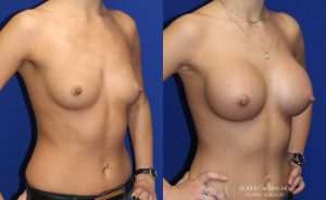  Woman's body, before and after Breast Augmentation treatment, oblique view, patient 1
