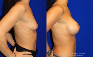  Woman's body, before and after Breast Augmentation treatment, r-side view, patient 8