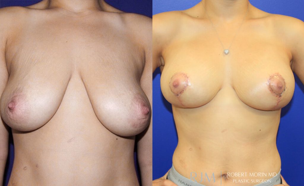  Woman's body, before and after Breast Augmentation treatment in New Jersey, front view, patient 38