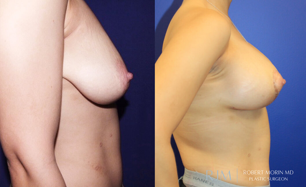  Woman's body, before and after Breast Augmentation treatment, r-side view, patient 35