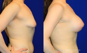  Woman's body, before and after Breast Augmentation treatment, r-side view, patient 26