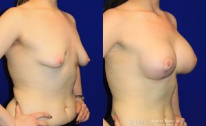  Woman's body, before and after Breast Augmentation treatment, oblique view, patient 26