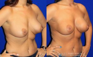  Woman's body, before and after Breast Augmentation treatment, front view, patient 31