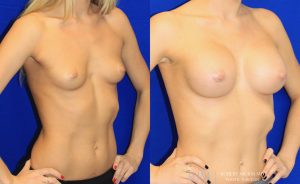  Woman's body, before and after Breast Augmentation treatment, oblique view, patient 4