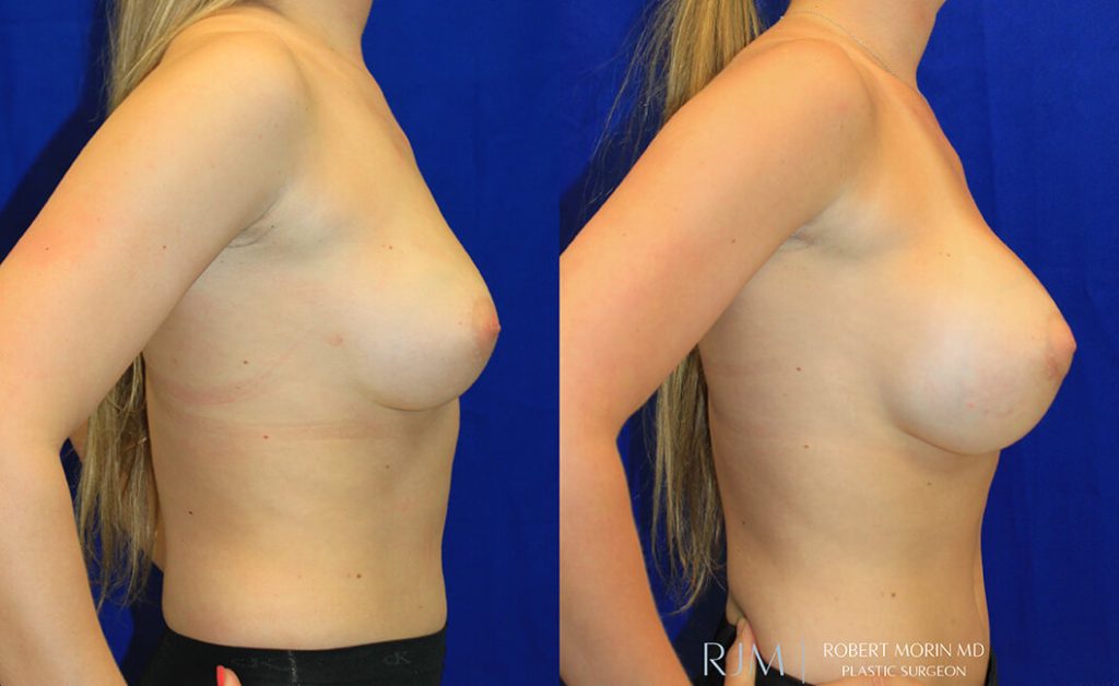  Woman's body, before and after Breast Augmentation treatment in New Jersey, r-side view, patient 20