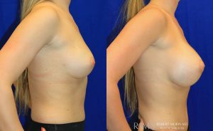  Woman's body, before and after Breast Augmentation treatment, r-side view, patient 17