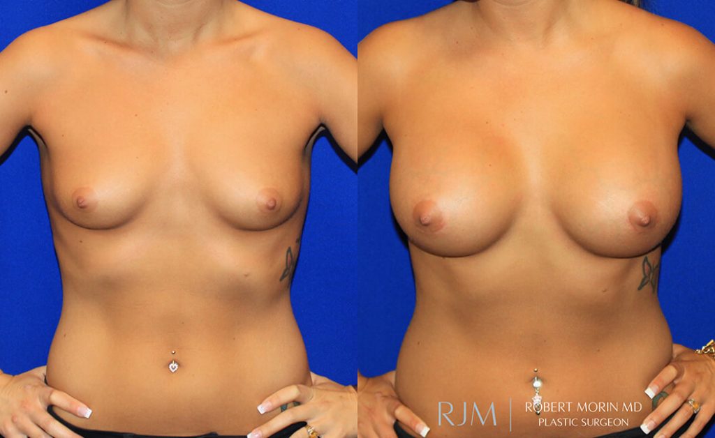  Woman's body, before and after Breast Augmentation treatment in New Jersey, front view, patient 2