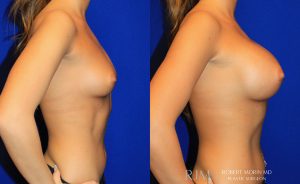  Woman's body, before and after Breast Augmentation treatment, r-side view, patient 2