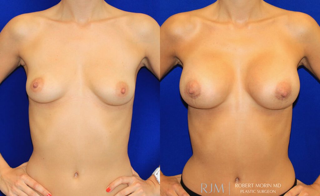  Woman's body, before and after Breast Augmentation treatment in New Jersey, front view, patient 6