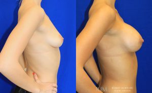  Woman's body, before and after Breast Augmentation treatment, r-side view, patient 5