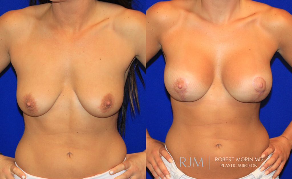  Woman's body, before and after Breast Augmentation treatment in New Jersey, front view, patient 41