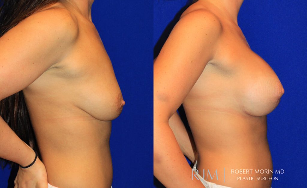  Woman's body, before and after Breast Augmentation treatment in New Jersey, r-side view, patient 41