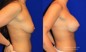  Woman's body, before and after Breast Augmentation treatment, r-side view, patient 38