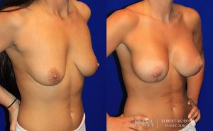  Woman's body, before and after Breast Augmentation treatment, oblique view, patient 38