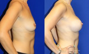  Woman's body, before and after Breast Augmentation treatment in New Jersey, r-side view, patient 21