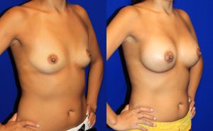  Woman's body, before and after Breast Augmentation treatment, front view, patient 22