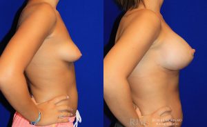  Woman's body, before and after Breast Augmentation treatment, r-side view, patient 20