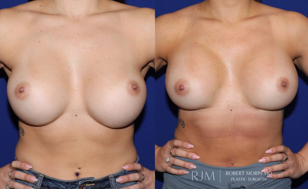  Woman's body, before and after Breast Augmentation treatment in New Jersey, front view, patient 30