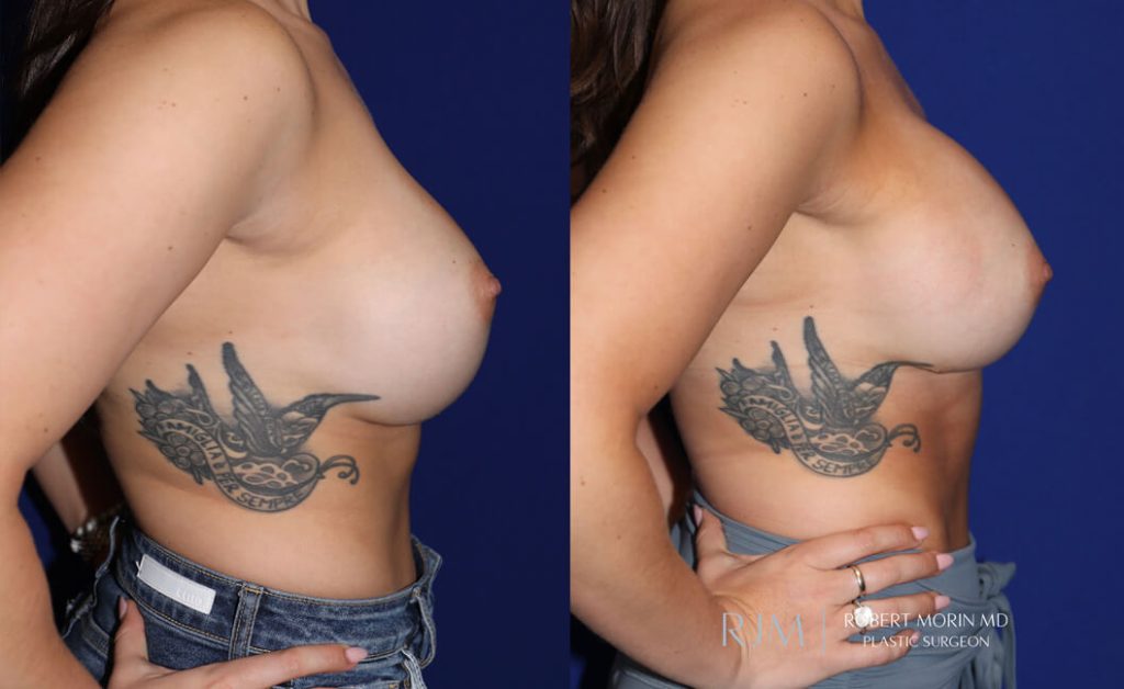  Woman's body, before and after Breast Augmentation treatment in New Jersey, r-side view, patient 30