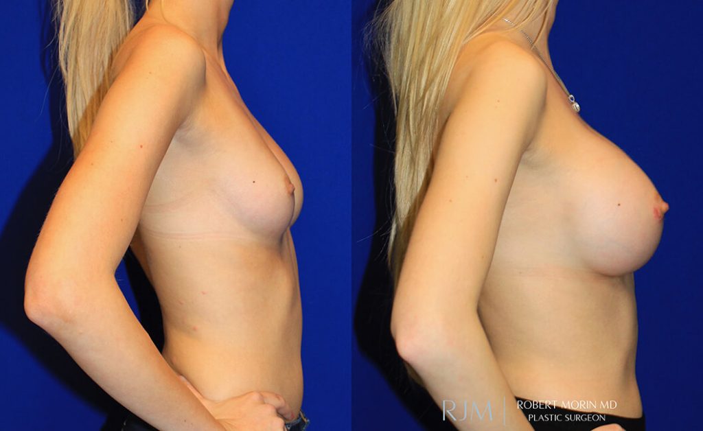  Woman's body, before and after Breast Augmentation treatment in New Jersey, r-side view, patient 22