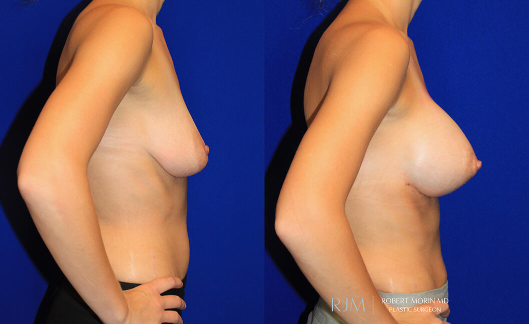  Woman's body, before and after Breast Augmentation treatment, r-side view, patient 36