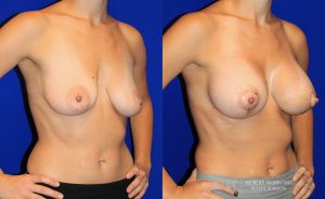  Woman's body, before and after Breast Augmentation treatment in New Jersey, oblique view, patient 39