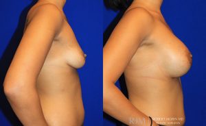  Woman's body, before and after Breast Augmentation treatment, r-side view, patient 23