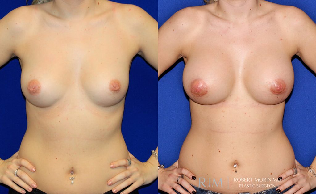  Woman's body, before and after Breast Augmentation treatment in New Jersey, front view, patient 28