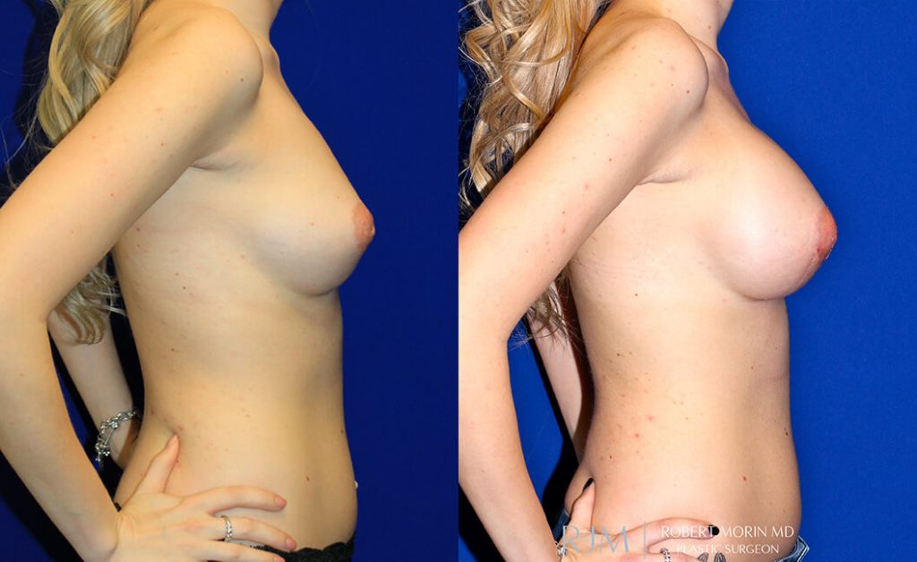  Woman's body, before and after Breast Augmentation treatment in New Jersey, r-side view, patient 28