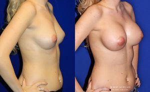  Woman's body, before and after Breast Augmentation treatment, oblique view, patient 25