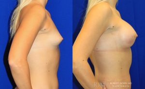 Woman's body, before and after Breast Augmentation treatment, r-side view, patient 21