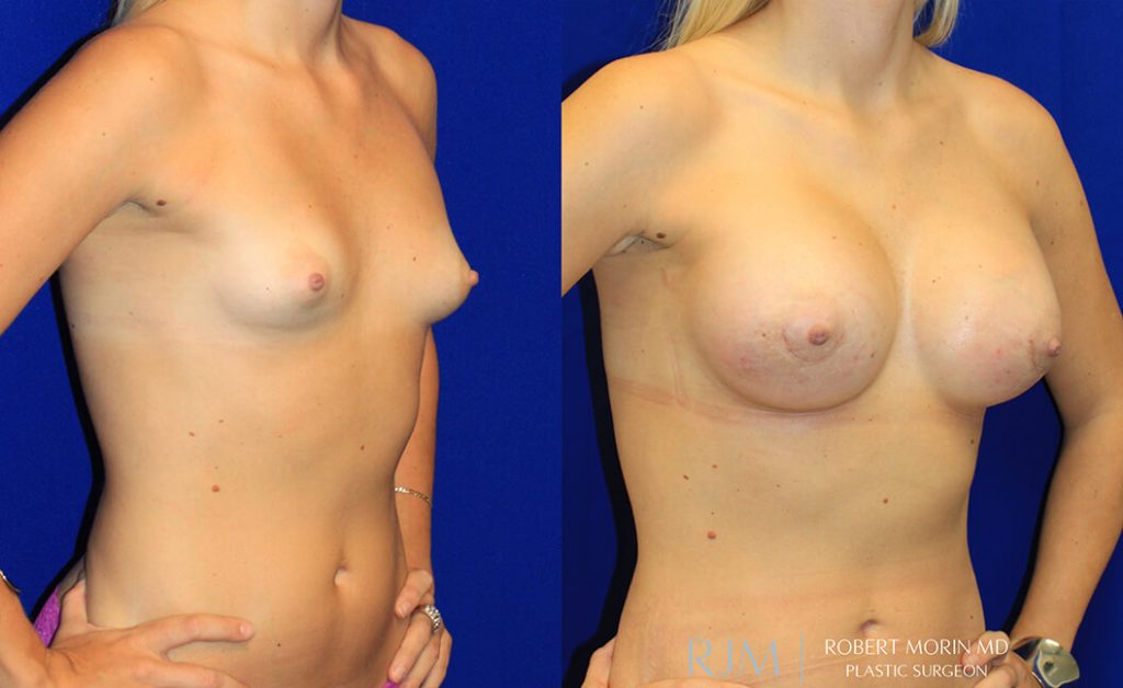  Woman's body, before and after Breast Augmentation treatment in New Jersey, oblique view, patient 24