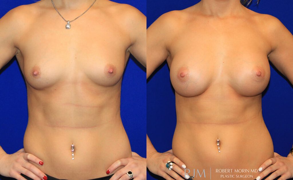  Woman's body, before and after Breast Augmentation treatment in New Jersey, front view, patient 3