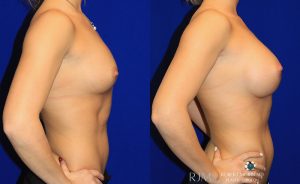  Woman's body, before and after Breast Augmentation treatment, r-side view, patient 3