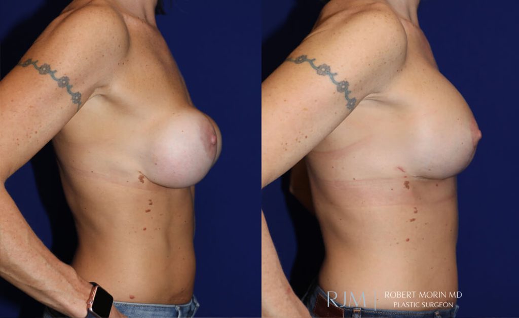  Woman's body, before and after Breast Augmentation treatment in New Jersey, r-side view, patient 31