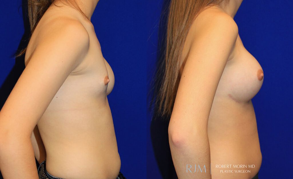  Woman's body, before and after Breast Augmentation treatment in New Jersey, r-side view, patient 44