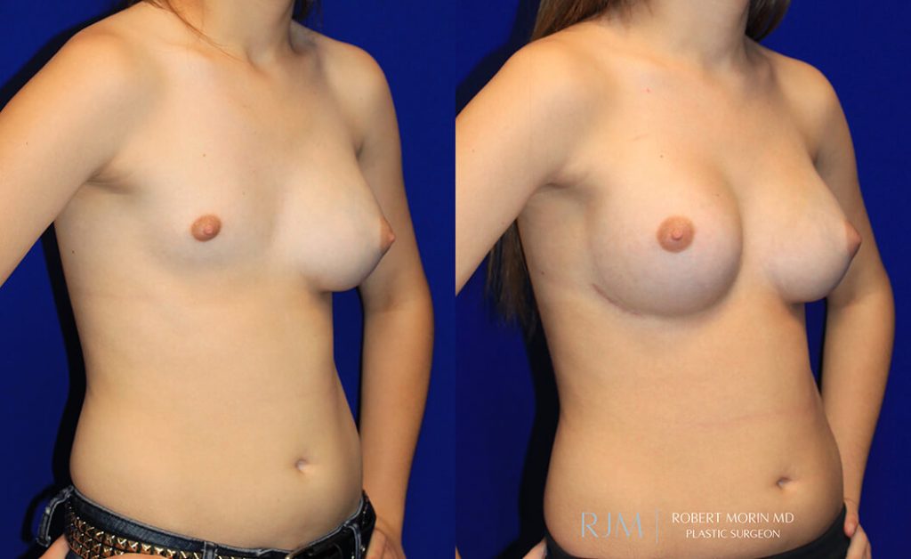  Woman's body, before and after Breast Augmentation treatment in New Jersey, oblique view, patient 44
