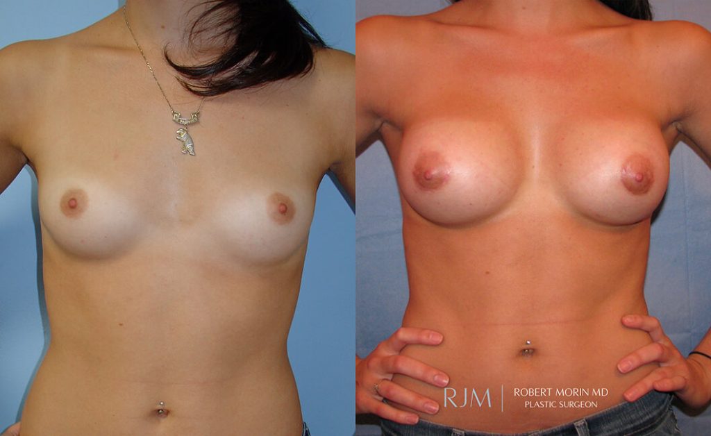  Woman's body, before and after Breast Augmentation treatment in New Jersey, front view, patient 16