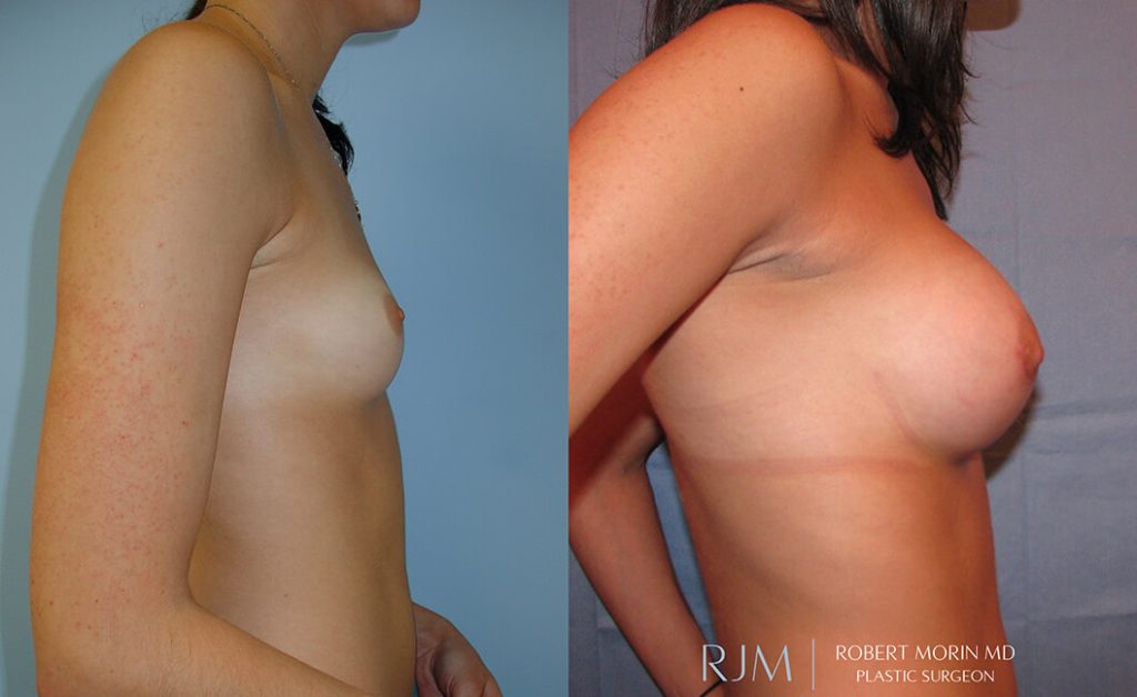  Woman's body, before and after Breast Augmentation treatment in New Jersey, r-side view, patient 16