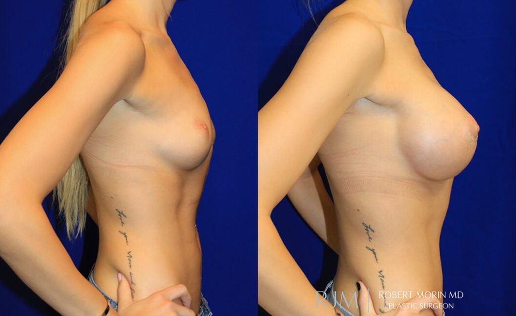  Woman's body, before and after Breast Augmentation treatment in New Jersey, r-side view, patient 15