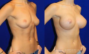 Woman's body, before and after Breast Augmentation treatment, oblique view, patient 12