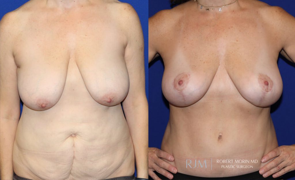  Woman's body, before and after Breast Augmentation treatment in New Jersey, oblique view, patient 33