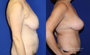  Woman's body, before and after Breast Augmentation treatment in New Jersey, r-side view, patient 33