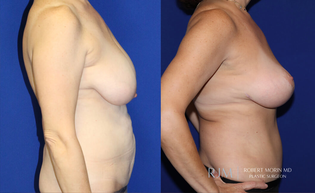  Woman's body, before and after Breast Augmentation treatment, r-side view, patient 30
